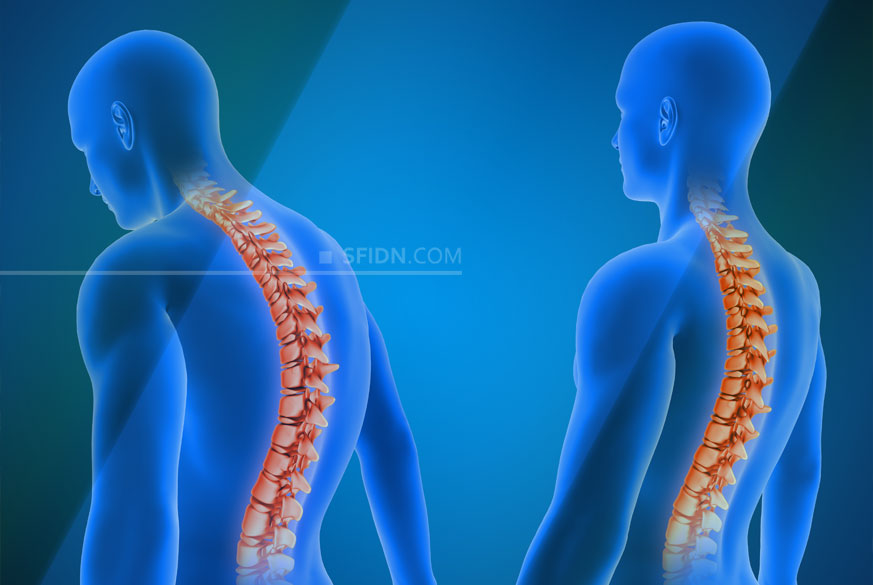 sfidn - Postur Badan Bungkuk Memicu Masalah Serius di Masa Depan